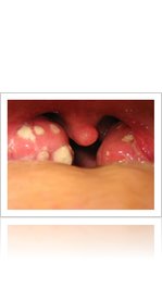 Tonsil Stones How To Remove